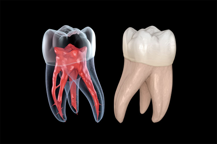 歯内療法(神経の治療)画像