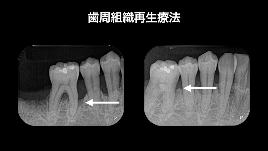 歯周病で抜歯と言われた歯の保存