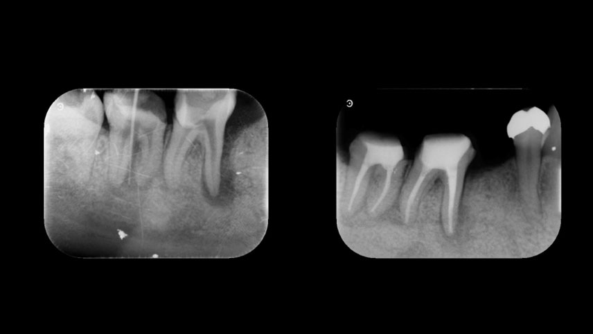 精密歯内療法で抜歯を回避した症例