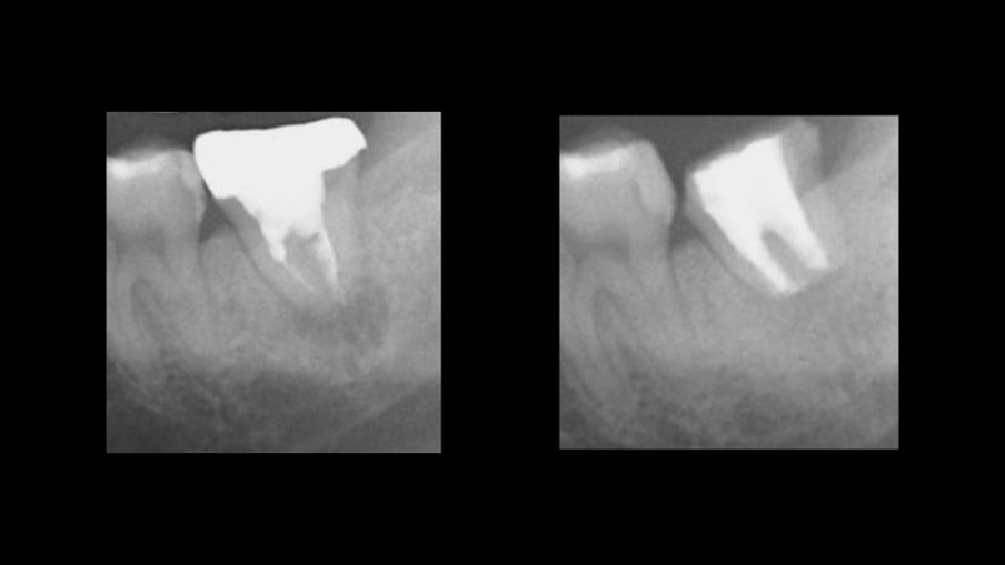 根の病変で抜歯と言われた歯の保存