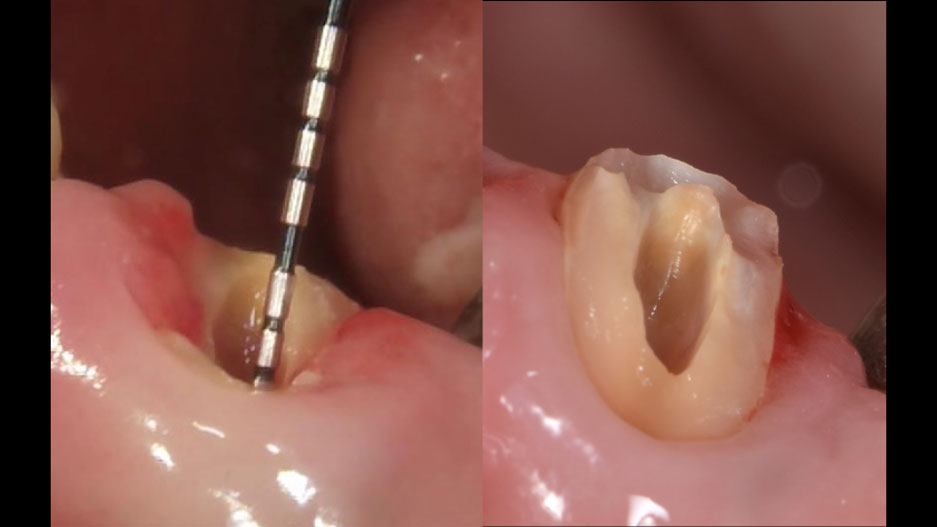 矯正的挺出により保存した症例